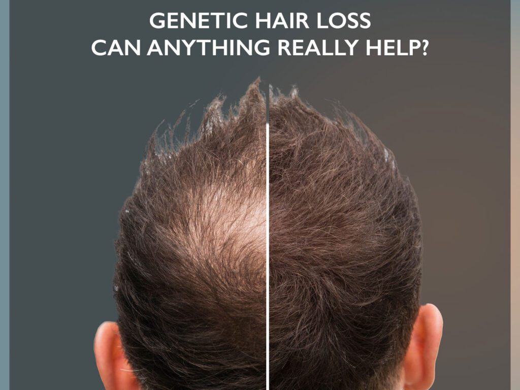 Genetic Hair Loss: Can Anything Really Help?